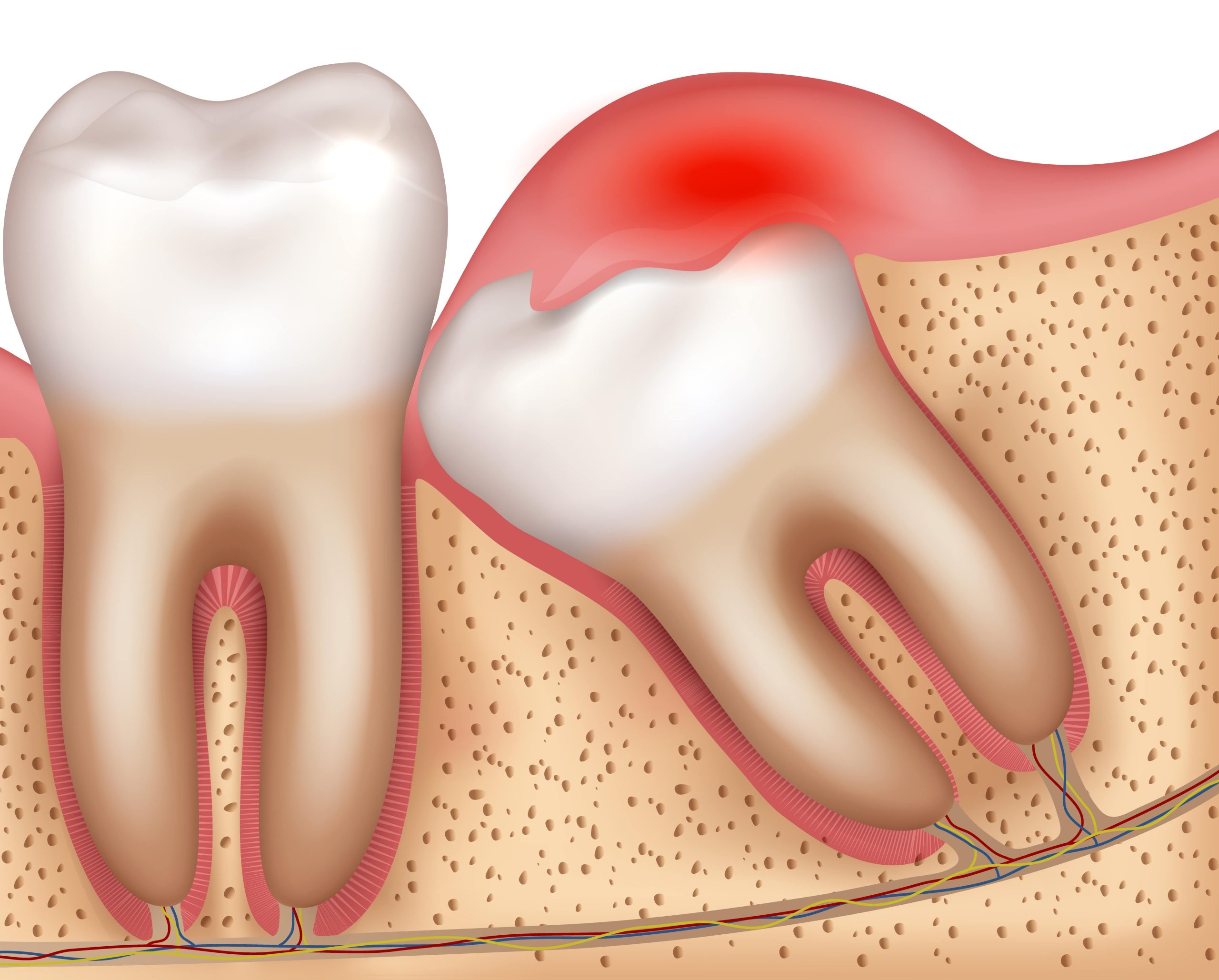 Illustration d'une dent semi-incluse infectée